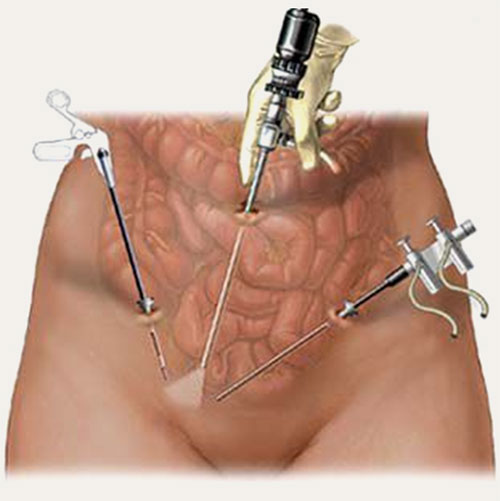 Recuperação da cirurgia de hérnia umbilical é simples - SBH